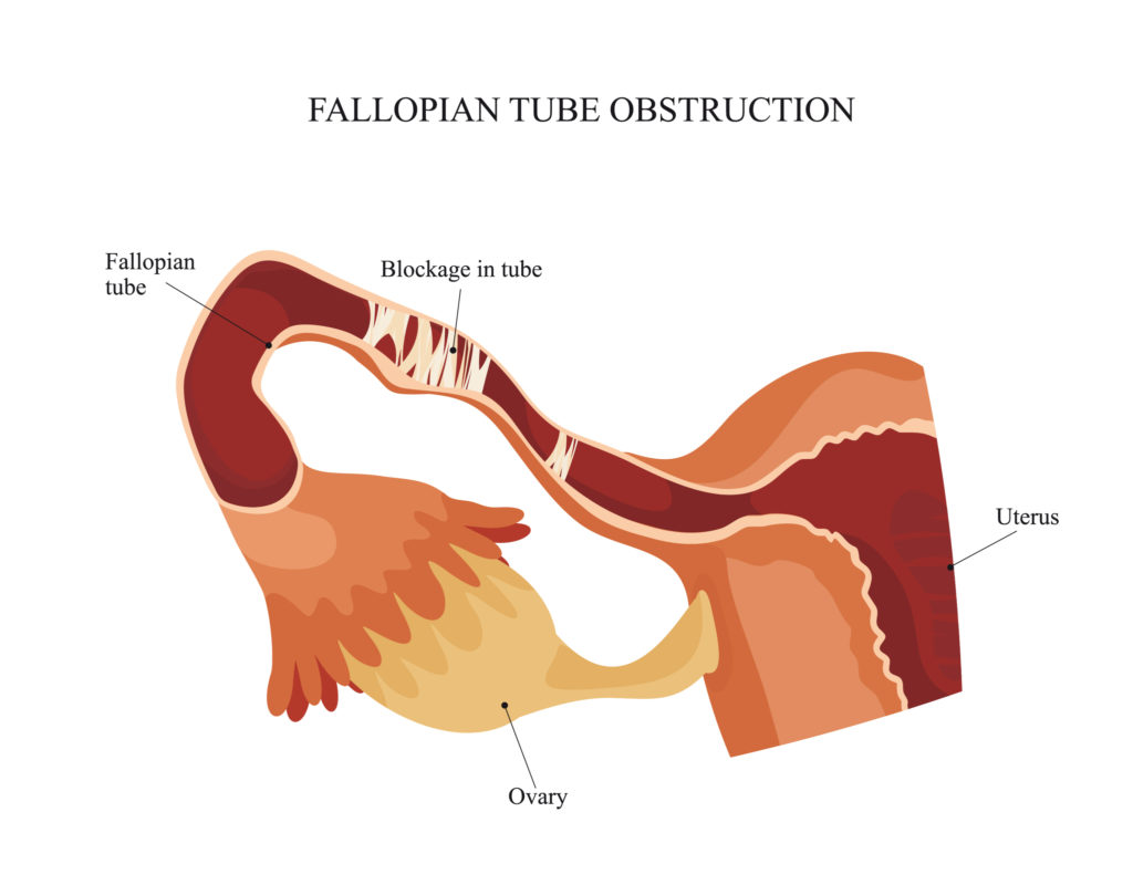 blocked fallopian tube