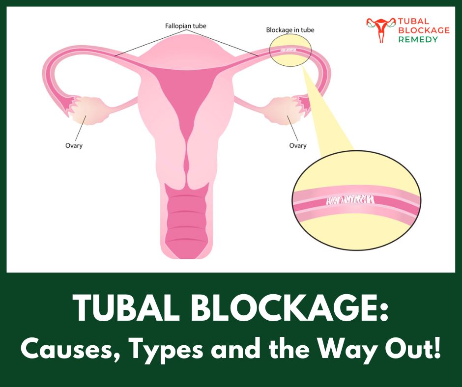 TUBAL BLOCKAGE: CAUSES, TYPES, SYMPTOMS AND THE WAY OUT