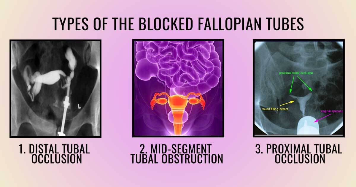 types of tubal blockage