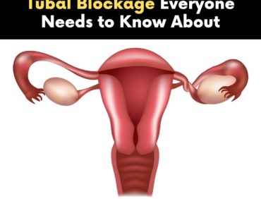 4 Major Causes of Tubal Blockage You Need to Know About