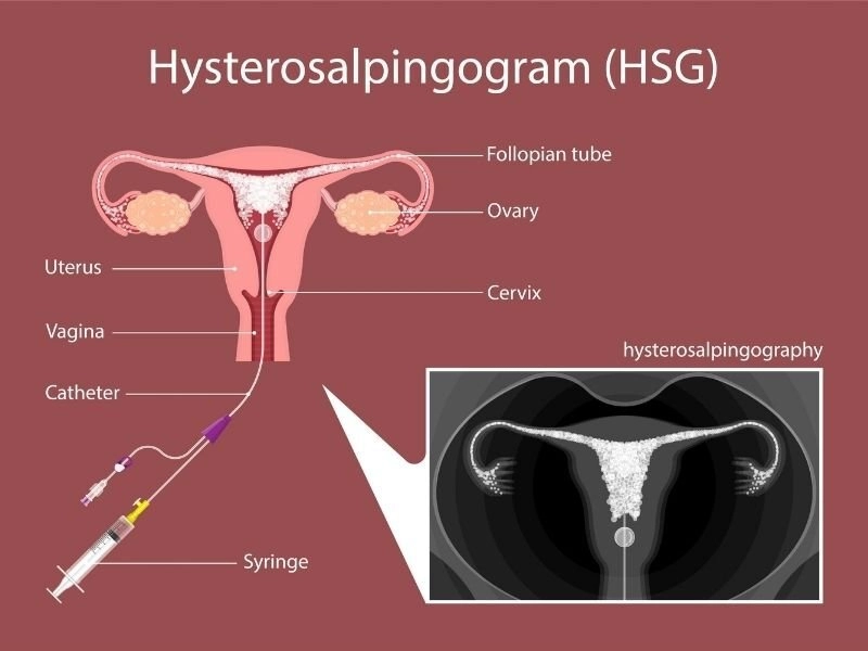Hysterosalpingogram 
