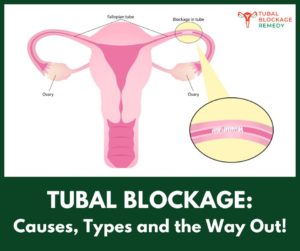 How to overcome tubal blockage naturally
